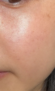 細紋、膚質粗糙