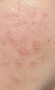 痘痘、閉鎖性粉刺